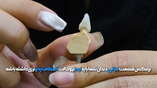 آیا استفاده از دندان مصنوعی آلمانی معقول است؟