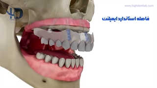 موشن گرافی مراحل کاشت پروتز ثابت (اُوردنچر)