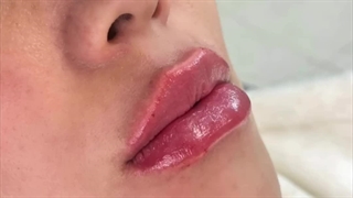 تزریق ژل لب عروسکی در کرج