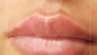 تزریق ژل لب نورامیس در کرج