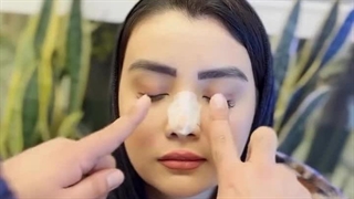 نحوه ماساژ بعد عمل بینی توسط دکتر علی شفیعی جراح بینی در سعادت آباد بررسی لک صورت