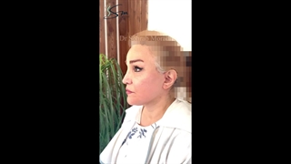 عملیة شد الوجه والخدود العمیقة