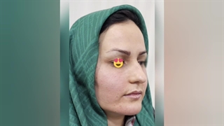 نمونه‌ای از تزریق چربی به صورت (6)