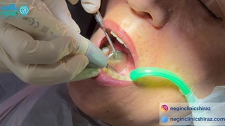 ویدیو جرم گیری زیر لثه - دکتر فائزه سعادتی