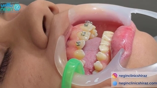 ویدیو شروع انجام ارتودنسی فک بالا - دکتر مینا مرادی