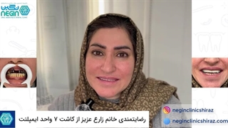 رضایتمندی خانم زارع عزیز از کاشت 7 واحد ایمپلنت فک بالا در شیراز