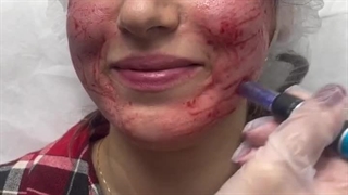 آیا مزونیدلینگ درد داره؟