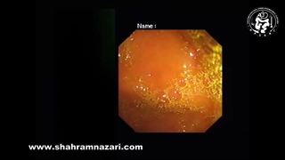 بستن با کلیپس در جلوگیری خونریزی پس از برداشتن آندوسکوپی پولیپ‌های بزرگ روده